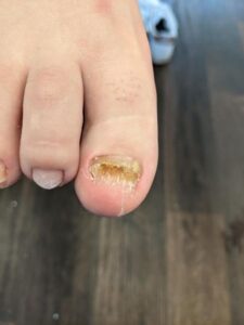 Before Medical Pedicure